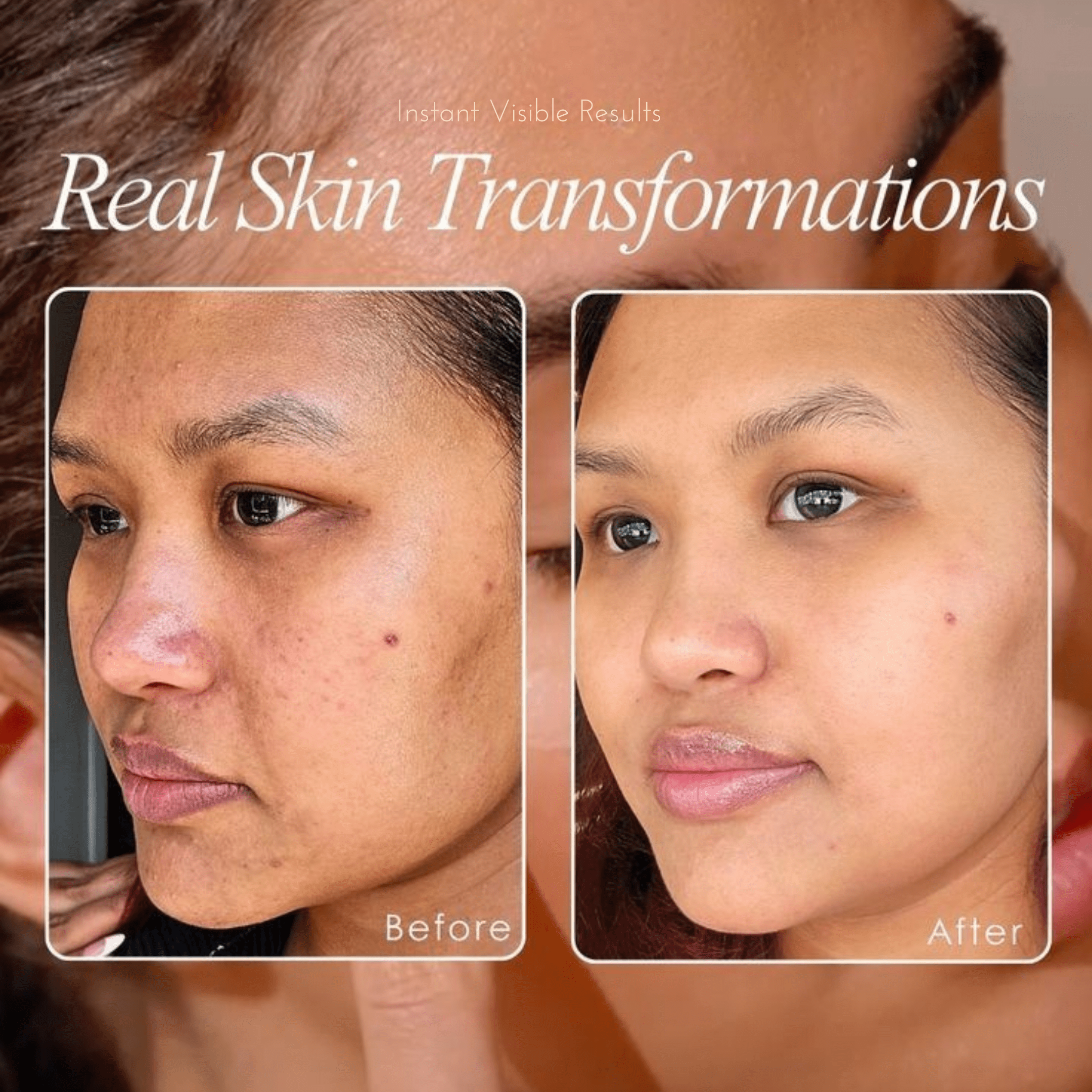 Before and after transformation of a woman's face with text 'Real Skin Transformations' and 'Instant Visible Results'.